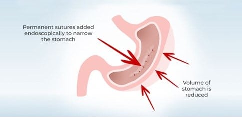 graphic of stomach showing the size reduction from endosleeve suturing