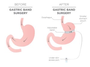 stomach graphic before and after gastric band surgery