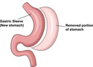 stomach graphic showing the removed portion after gastric sleeve surgery