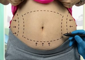 surgical markings on stomach for tummy tuck procedure