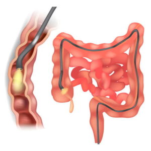 colon graphic with endoscope