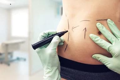 doctor marking abdomen of patient with surgical ink