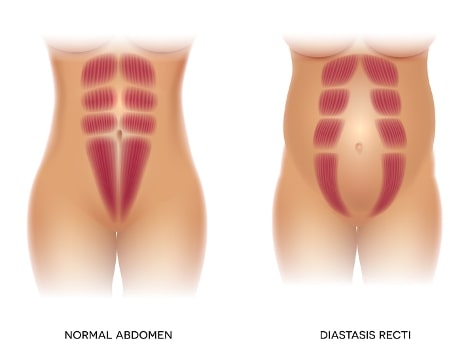 10 weeks post partum and coming to terms with diastasis recti