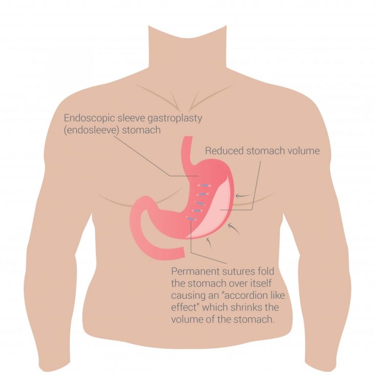 vector image of a torso with stomach visible depicting the suturing of the stomach. the sutures cause the stomach to fold and shrink in volume
