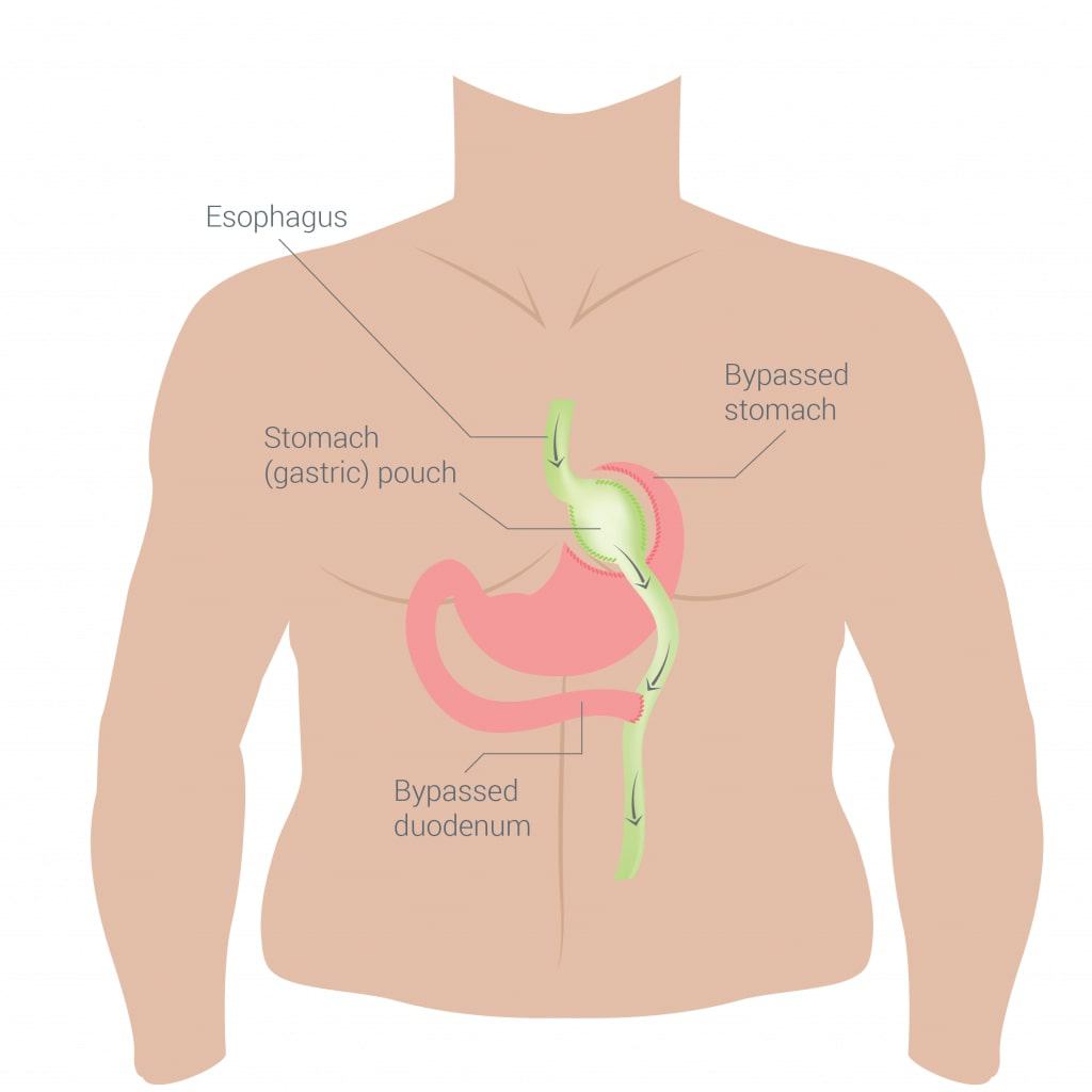 vector image of a torso with stomach visible depicting the re-routing of the gastric tract to bypass the stomach.