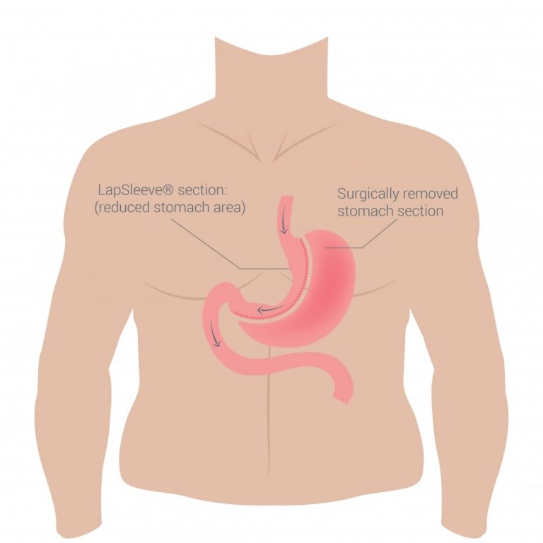 vector image of a torso with stomach visible depicting the removal of a section of the stomach, creating the "gastric sleeve"