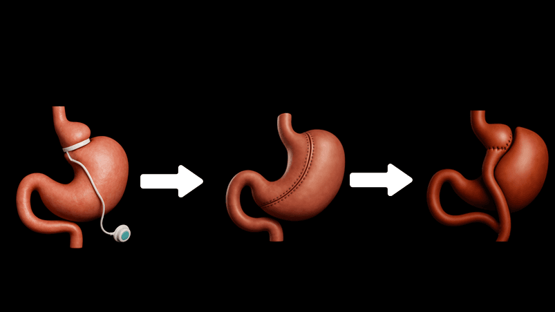Gastric Revision 3d Stomach