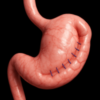 3D illustration of a stomach after endoscopic sleeve gastroplasty (ESG), showing internal sutures reducing the stomach volume without surgical removal.