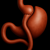 3D illustration of a stomach after gastric bypass surgery, showing the small pouch connected directly to the small intestine, bypassing the lower stomach.