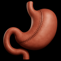3D illustration of a stomach after sleeve gastrectomy, showing the reduced, tube-shaped stomach with surgical sutures.