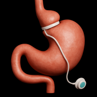 3D illustration of a stomach with an adjustable gastric band in place, showing the band around the upper portion and connected to a port.