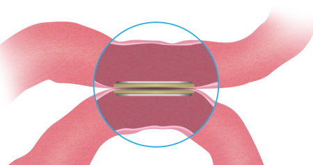 Mag-DI-Procedure-2D-Step-3.png
