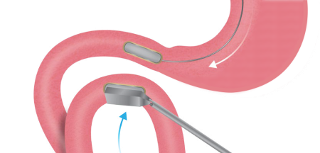 Mag-DI-Procedure-2D-Transparent-Step-2.png